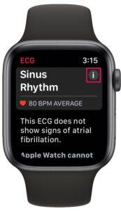 how-to-record-ecg-on-apple-watch-6-173x300-1 how-to-record-ecg-on-apple-watch-6-173x300-1